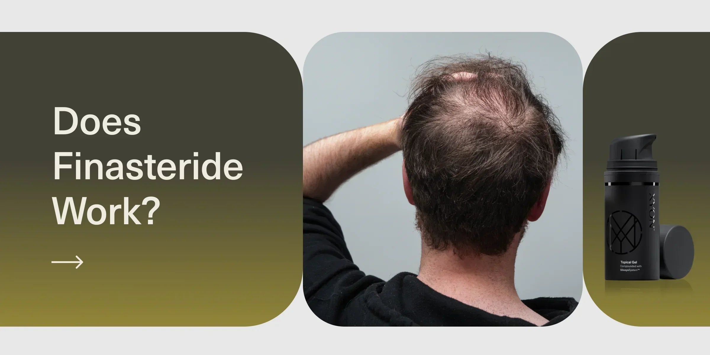 Does Finasteride Work?