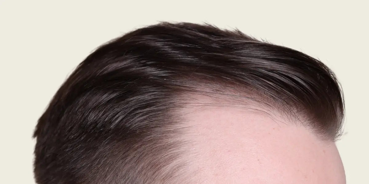 Does Minoxidil Work for a Receding Hairline