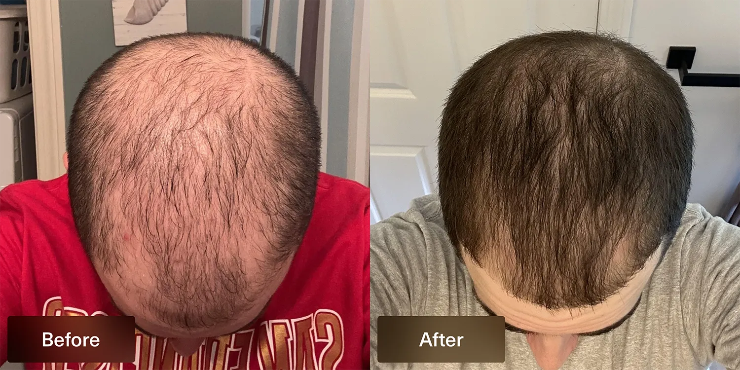 before and after photo of Xyon Health patient after using topical finasteride top view of head