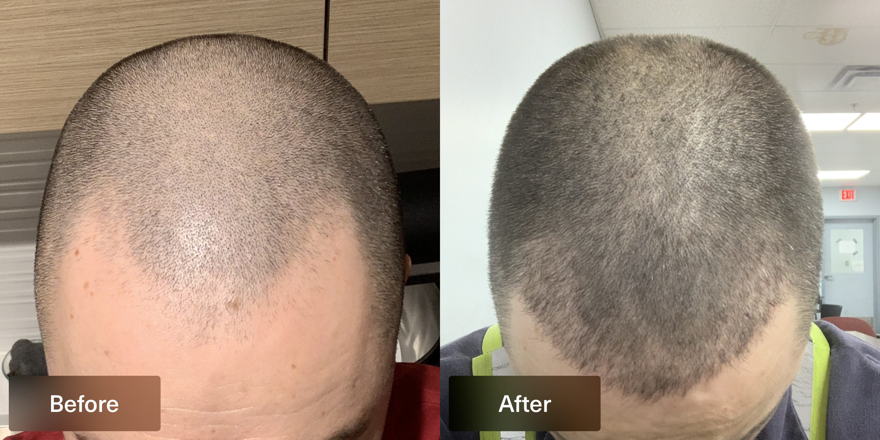 topical dutasteride before and after photo of Xyon Health patient showing hair growth results