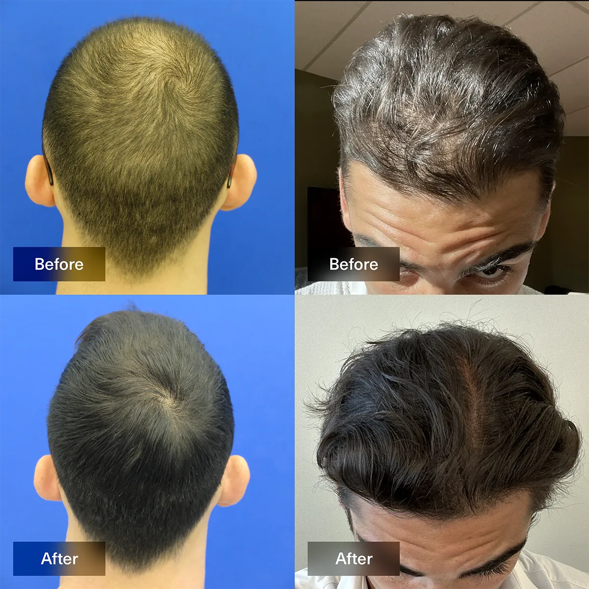 Xyon health topical dutasteride before and after photos of patient results
