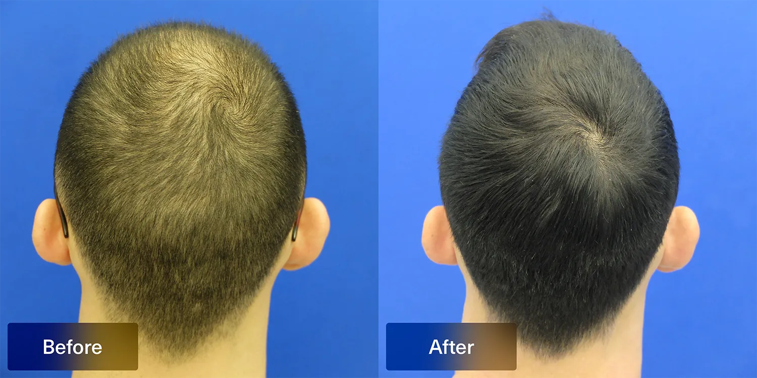XYON topical dutasteride patient before and after of crown area of the head