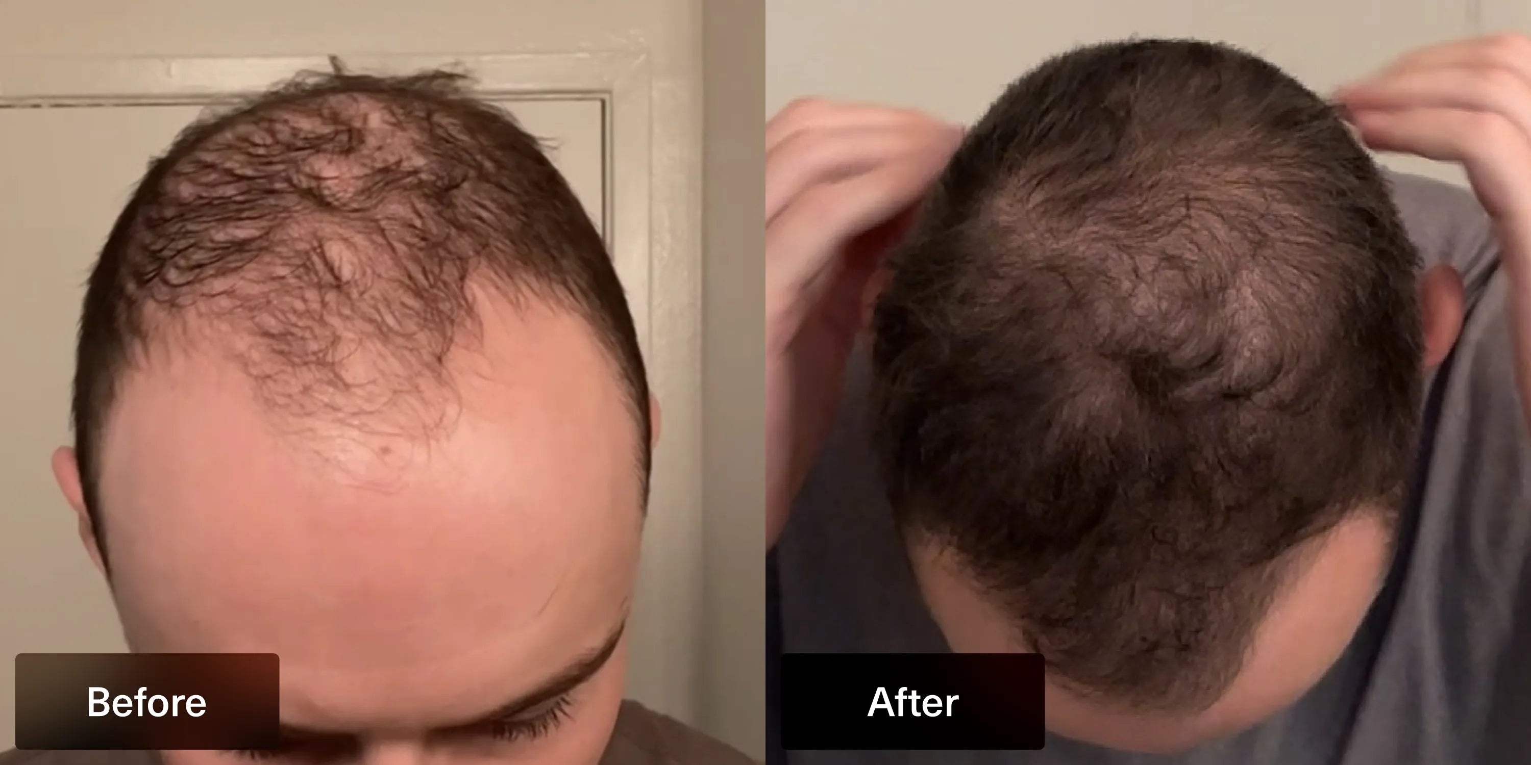 before and after photo of Xyon Health patient after using topical finasteride