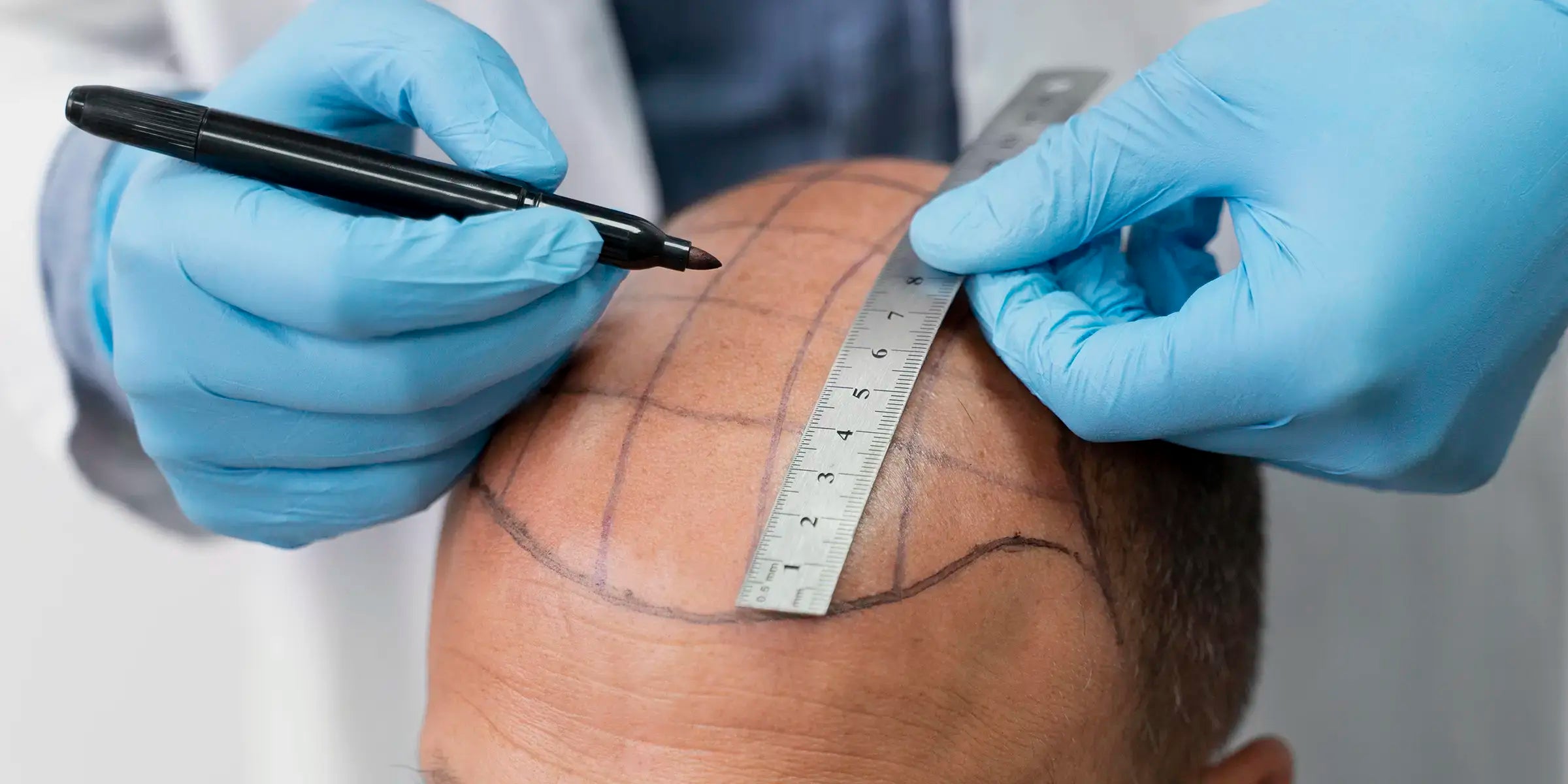hair transplant to solve male pattern baldness