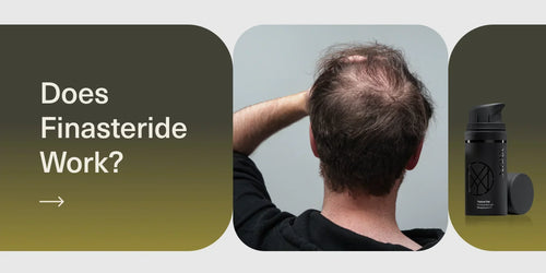 Does finasteride work?