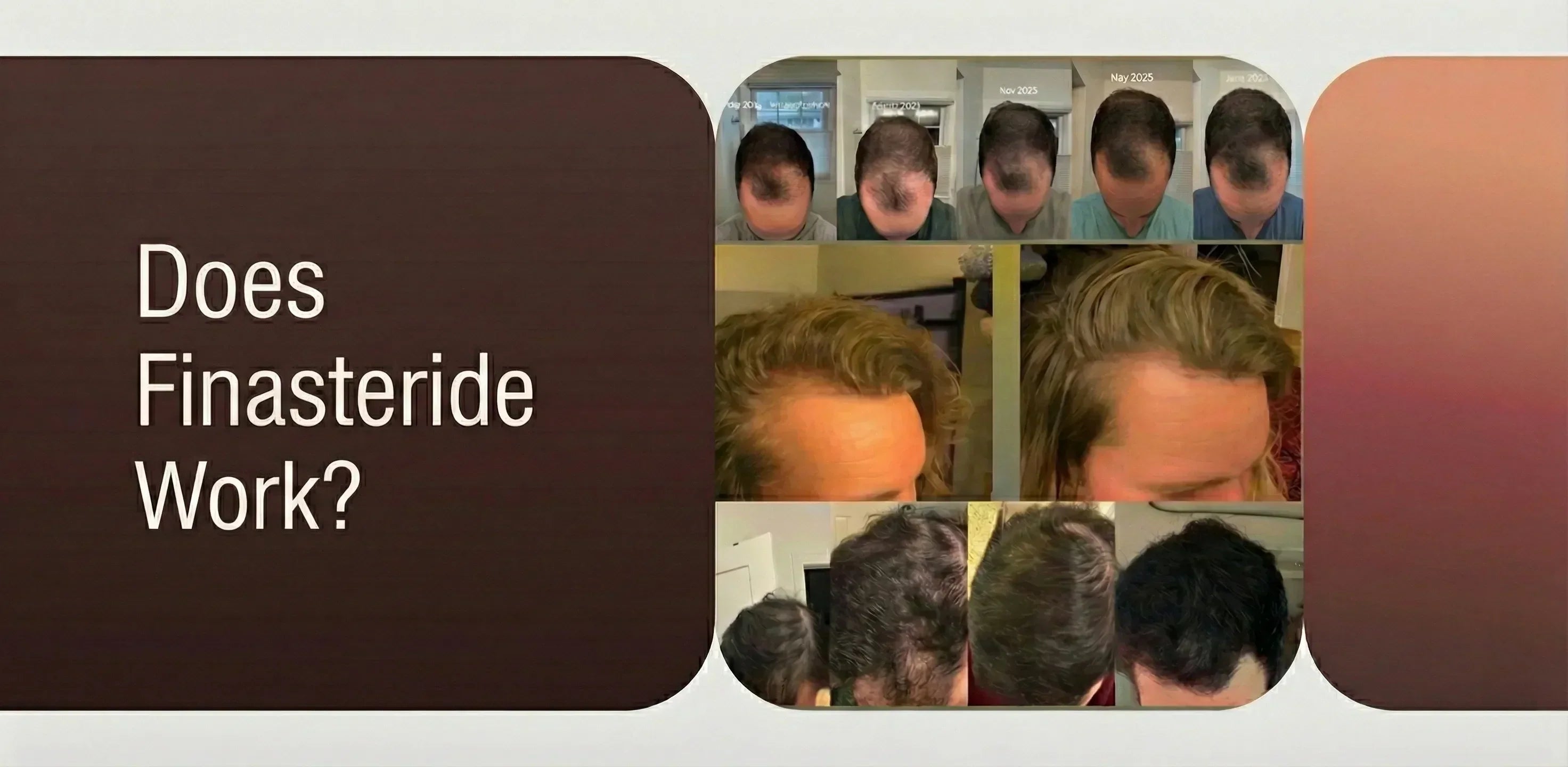 banner image for article on Does Finasteride Work?
