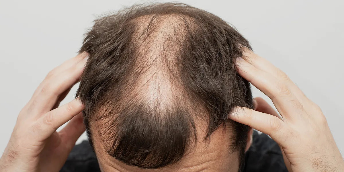 Man with advanced hair loss according to the Hamilton Norwood scale.