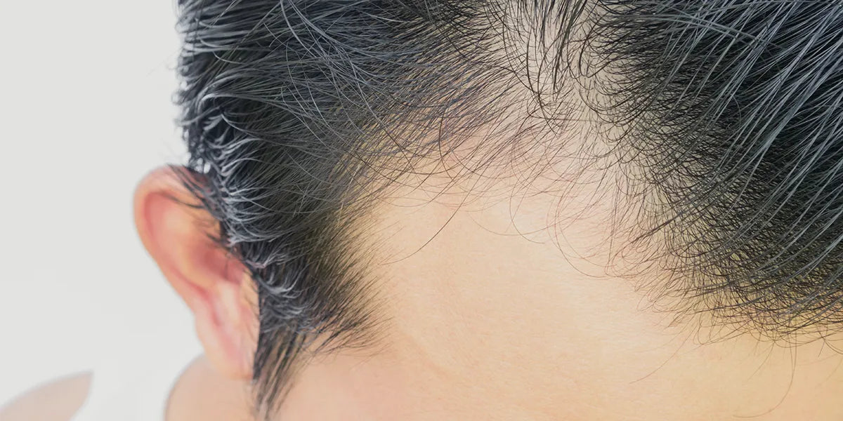 Man with dark hair with early signs of receding hair line who might benefit from dutasteride for hair loss.