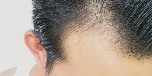 Dutasteride for hair loss
