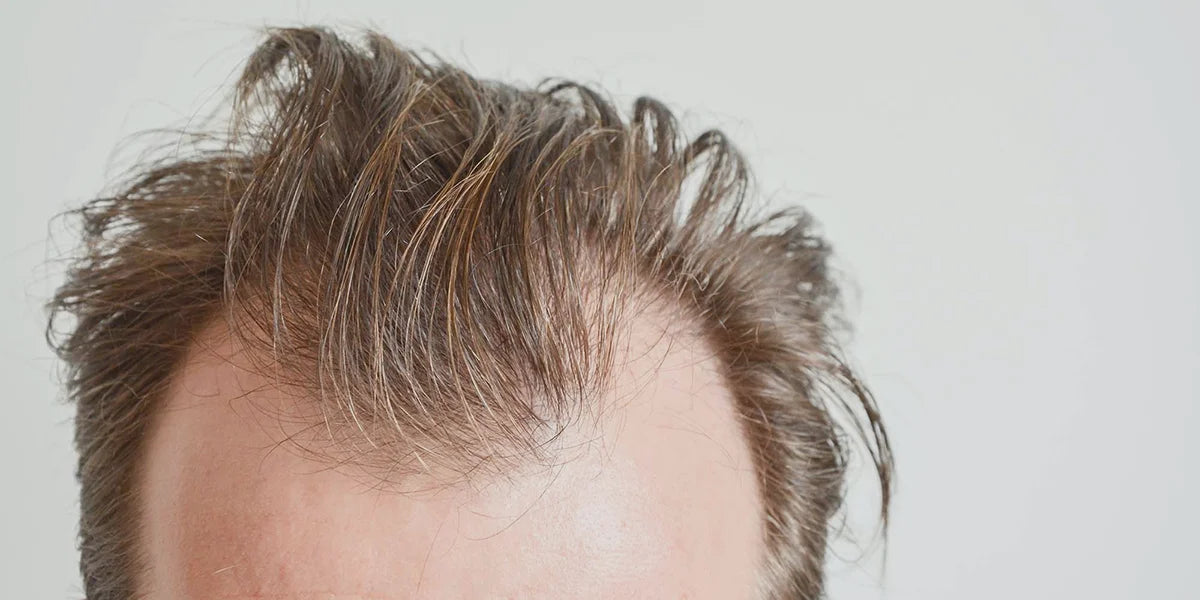 Man with hair loss showing finasteride regrowing hairline.