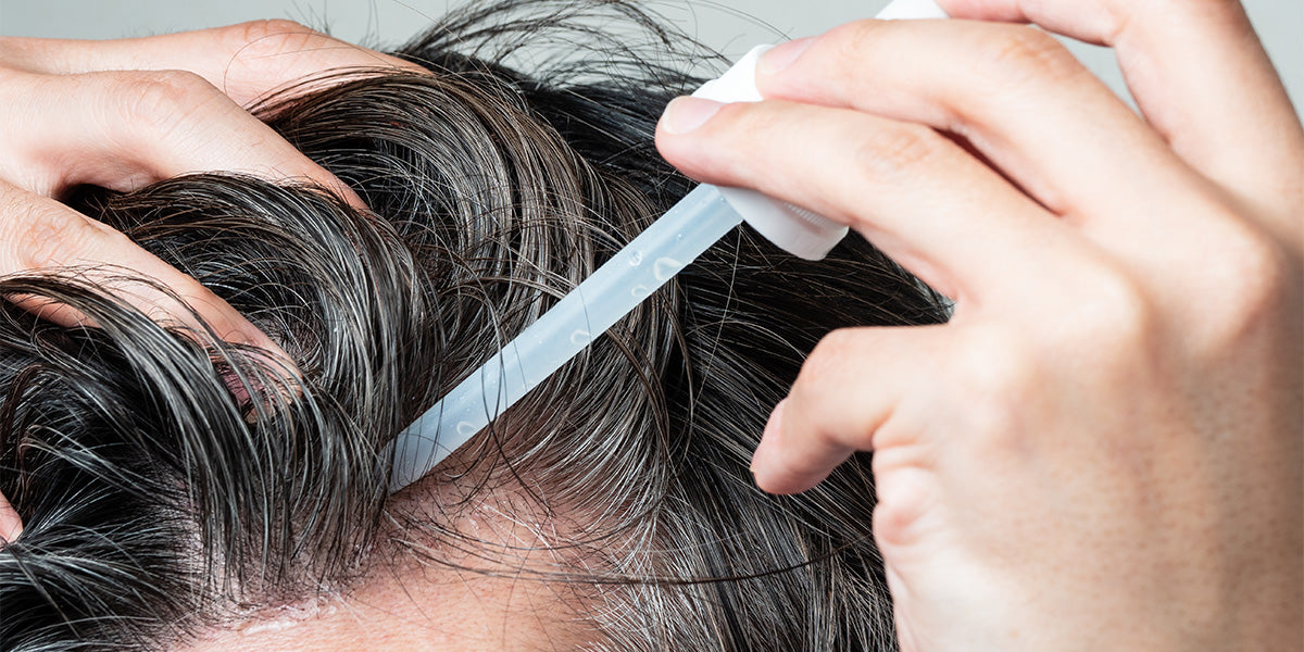 Man applying Rogaine to scalp for hair loss.