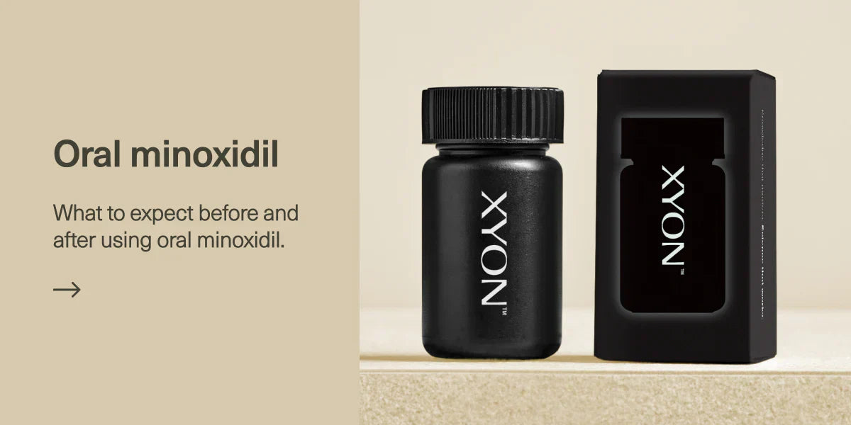 Before and After Using Oral Minoxidil