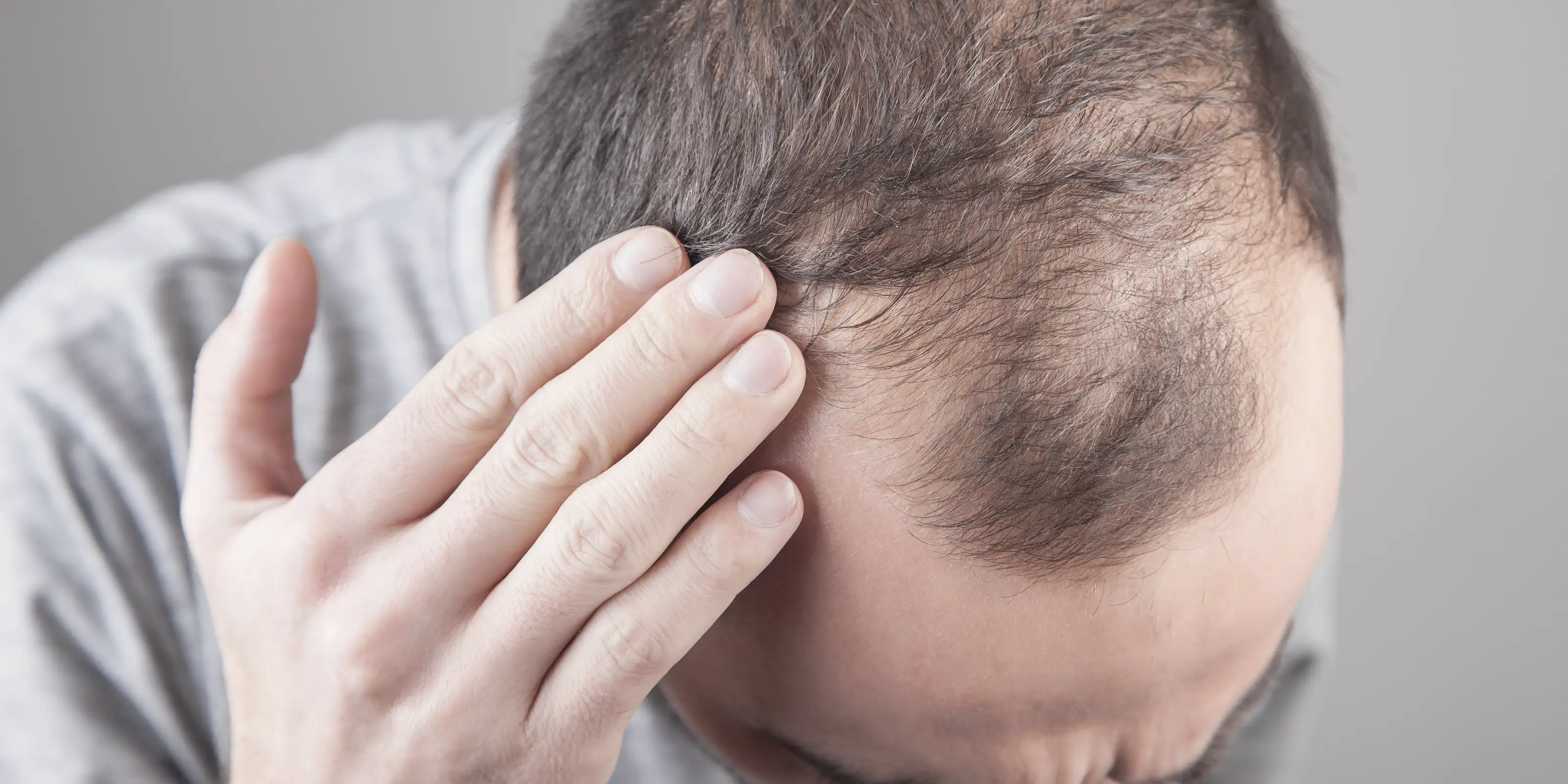 DHT and Hair Loss