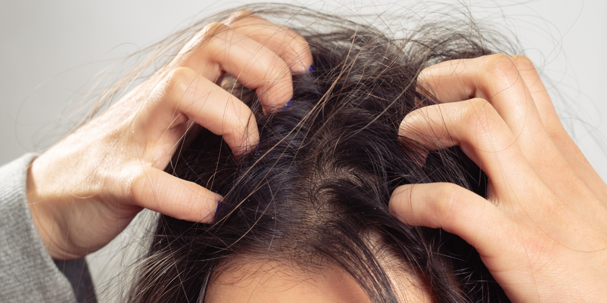 woman scratching inflamed scalp that has caused hair loss