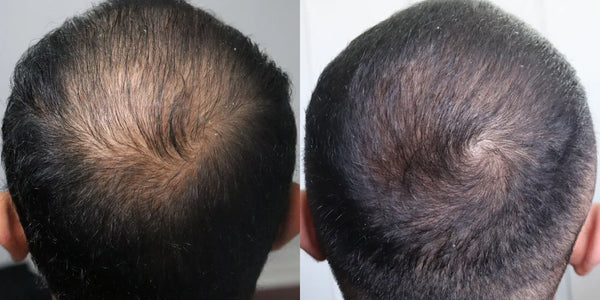 before and after 6 months of using topical finasteride 