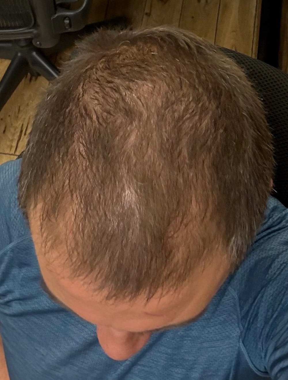Case Topical Finasteride + Minoxidil · Norwood V · 10 months — after treatment