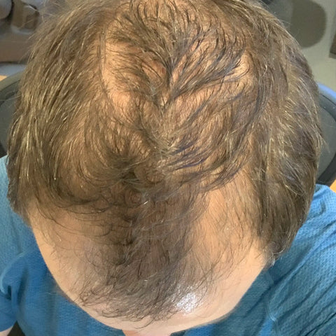 A.B. — before treatment