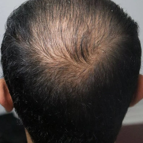 A.H. — before treatment