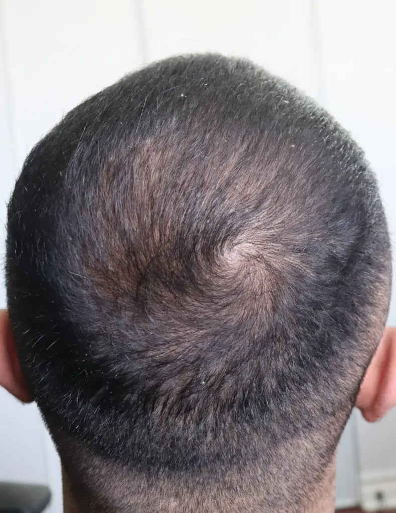 Case Topical Finasteride · Norwood III (vertex) · 6 months — after treatment