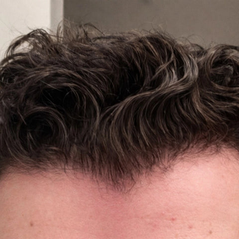C.D. — before treatment