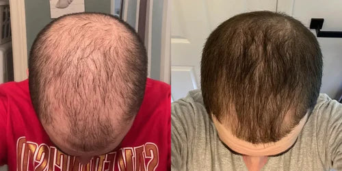 Chris's hair journey before and after using topical finasteride, showcasing significant hair regrowth and improved thickness.