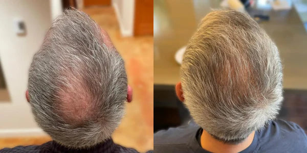 before and after 3 months of xyon topical finasteride 