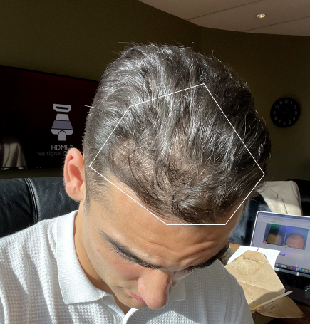 A XYON topical dutasteride user shows what their hair looked like before using the treatment