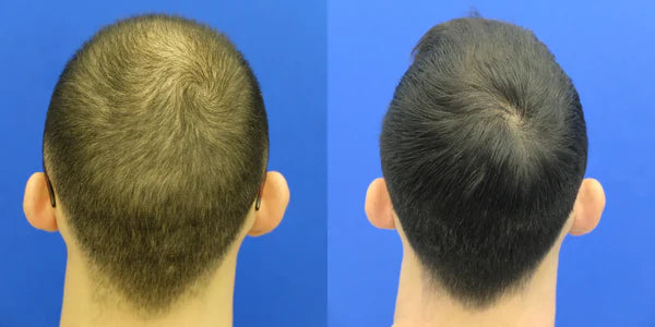 G.Y.'s before and after results with topical dutasteride, highlighting noticeable hair regrowth and improved density.