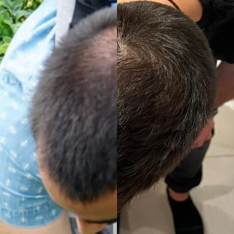 before and after results of using xyon topical finasteride slider image