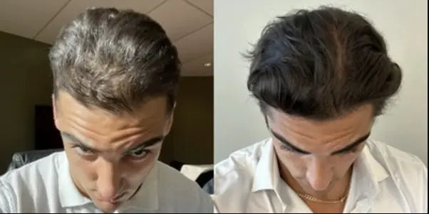 J.V.'s hair improvement results with XYON topical finasteride, highlighting increased density and regrowth.