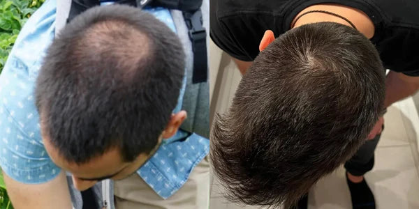 J.V.'s before and after results with topical finasteride plus minoxidil, showcasing improved hair thickness and regrowth.