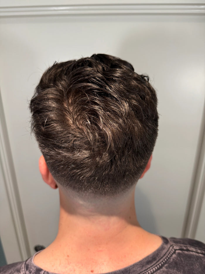 Case Topical Finasteride + Minoxidil · Norwood III (vertex) · 11 months — 5 Months