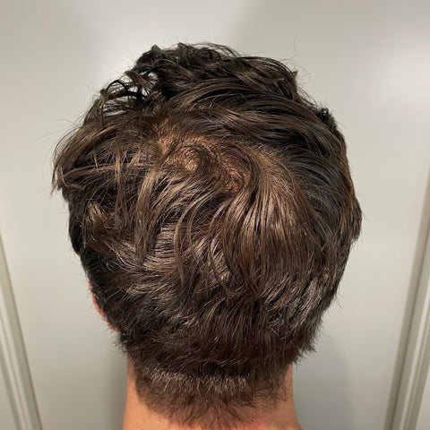 J.B. — before treatment