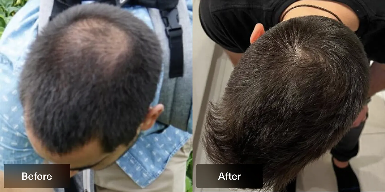 before and after photo of Xyon Health patient after using topical finasteride overhead view of head