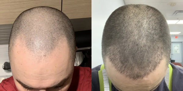 M.D.'s before and after results with XYON topical finasteride, showcasing significant hair regrowth and improved density.