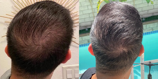 Before and after image of user ML on xyon topical dutasteride for 9 months