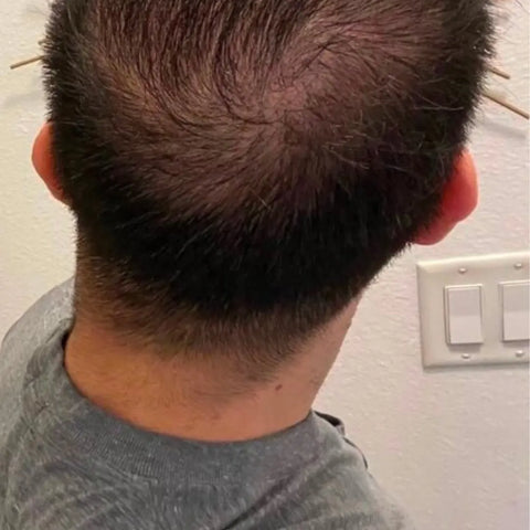 M.L. — before treatment