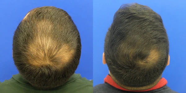 before and after results of topical finasteride after 2 years