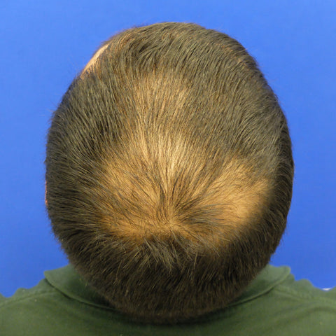 S.B. — before treatment