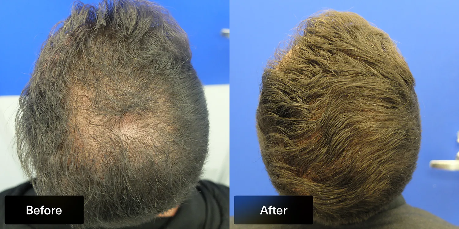 before and after photo of Xyon Health patient after using topical finasteride in the crown area