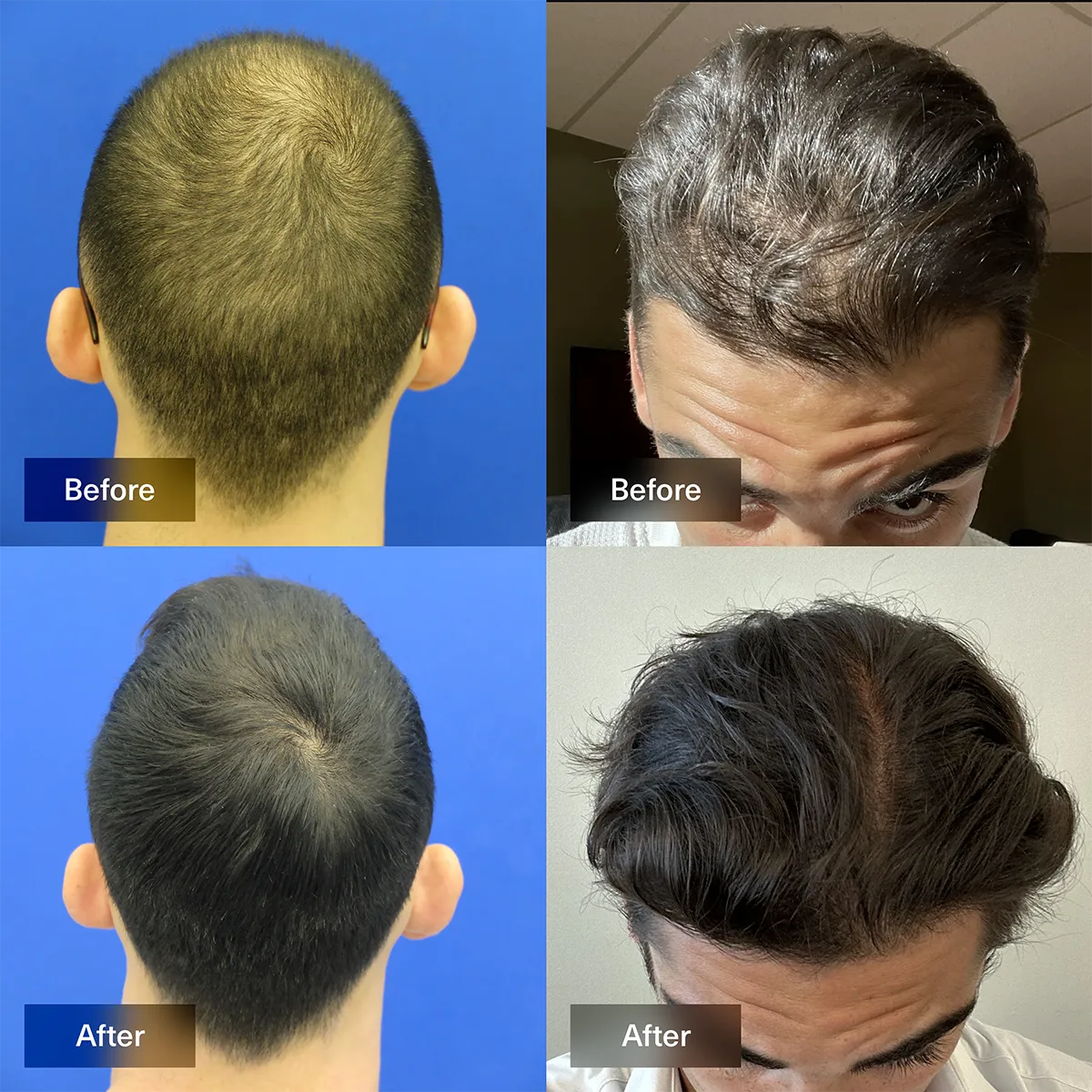 Topical Gel for Hair Loss