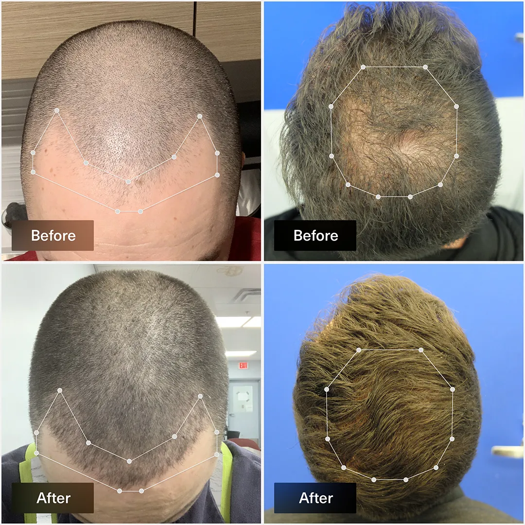 Topical Gel for Hair Loss
