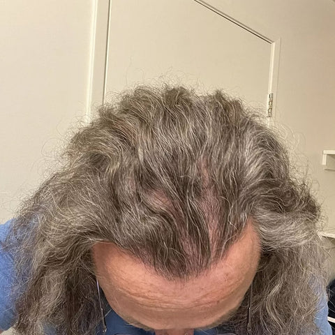 T.E. — before treatment