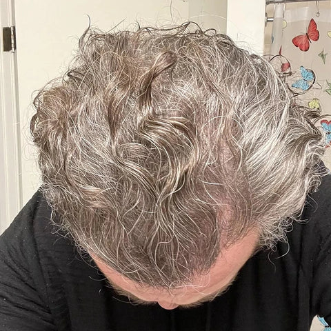 T.E. — after treatment