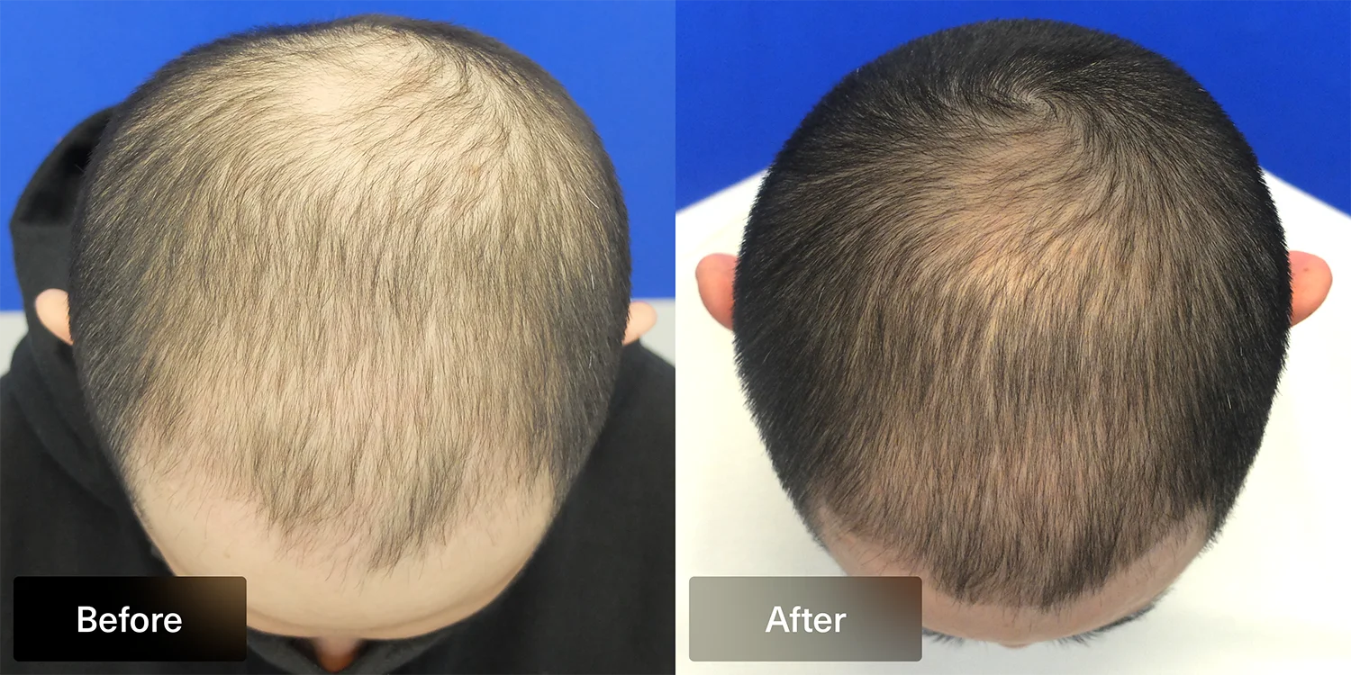 Overhead before and after hair loss result images of a XYON patient taking topical dutasteride