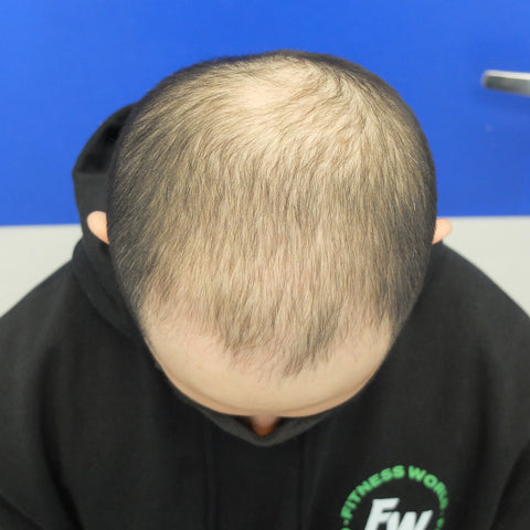 V.Y.X. — before treatment