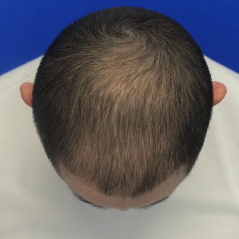 V.Y.X. — after treatment
