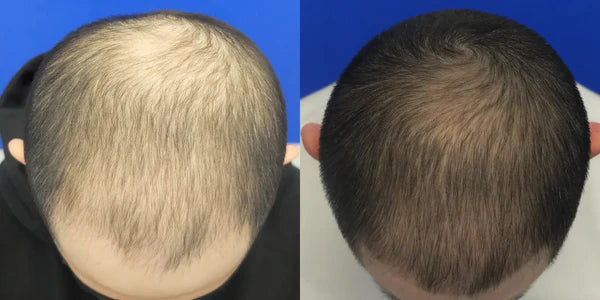3 month before and after topical finasteride 