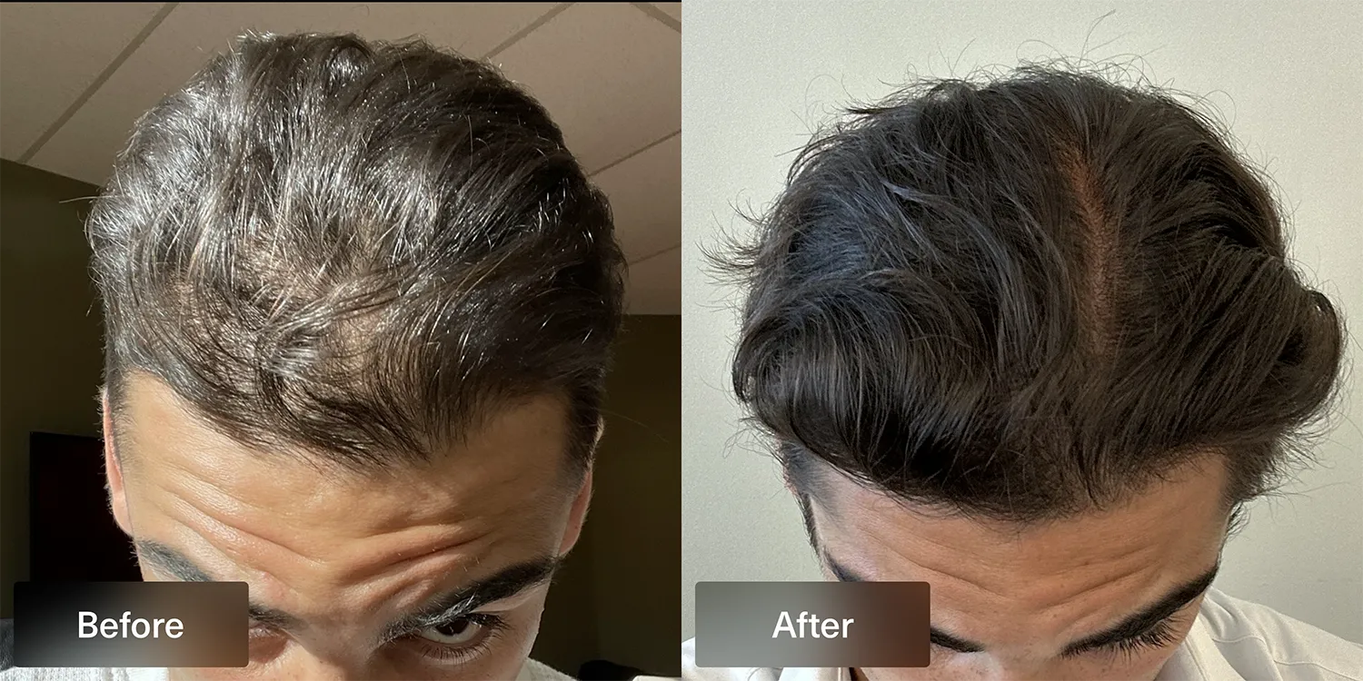 XYON topical dutasteride patient before and after results of hairline