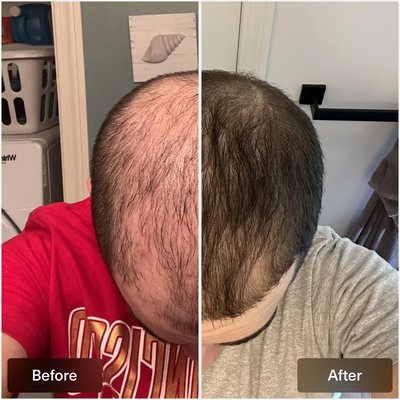 Topical Gel for Hair Loss